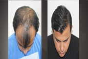  Hair Replacement Service